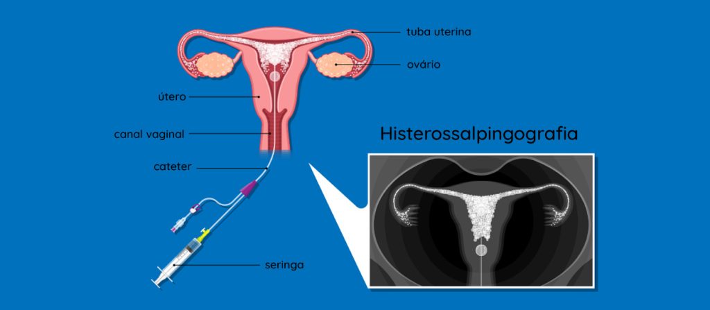 Histerossalpingografia - Reprodução Humana | Dr Luiz Henrique