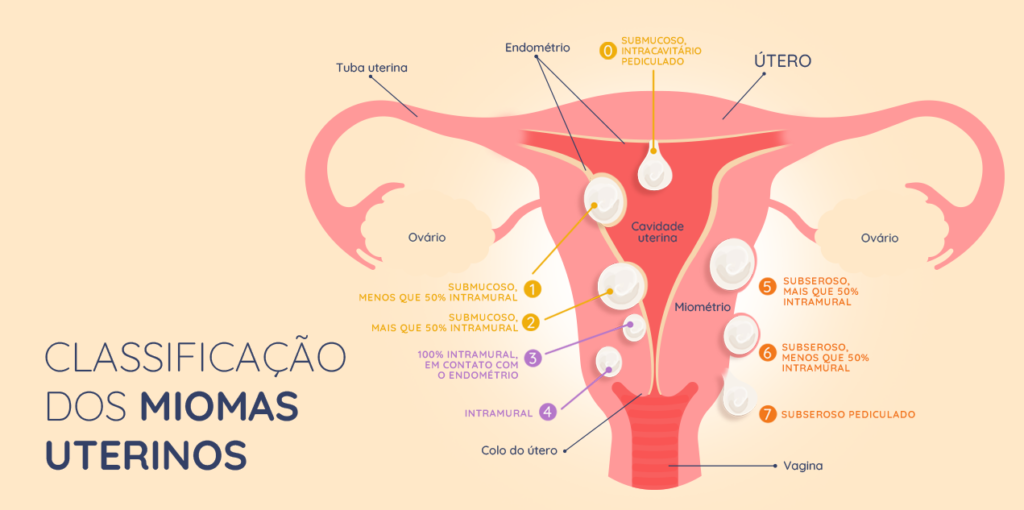 Mioma: conheça os sintomas para suspeitar da doença - Reprodução Humana ...